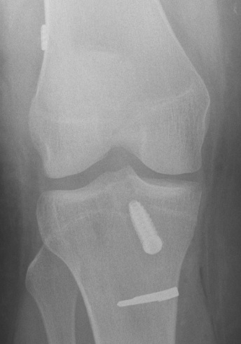 ACL Reconstruction Hamstring Endobutton RCI Screw AP